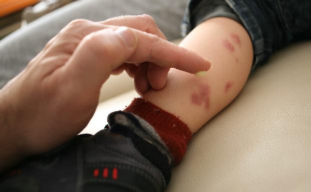 Dermatitis atopica alimentacion sana